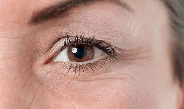 年纪轻轻眼部就长皱纹?日常做好这些很快改善